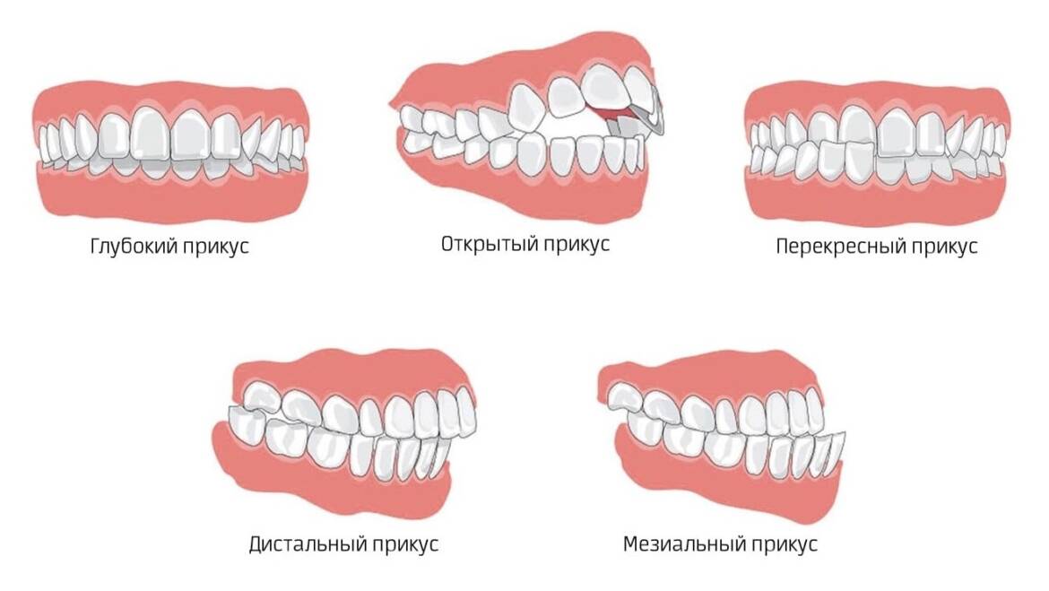 Виды прикусов
